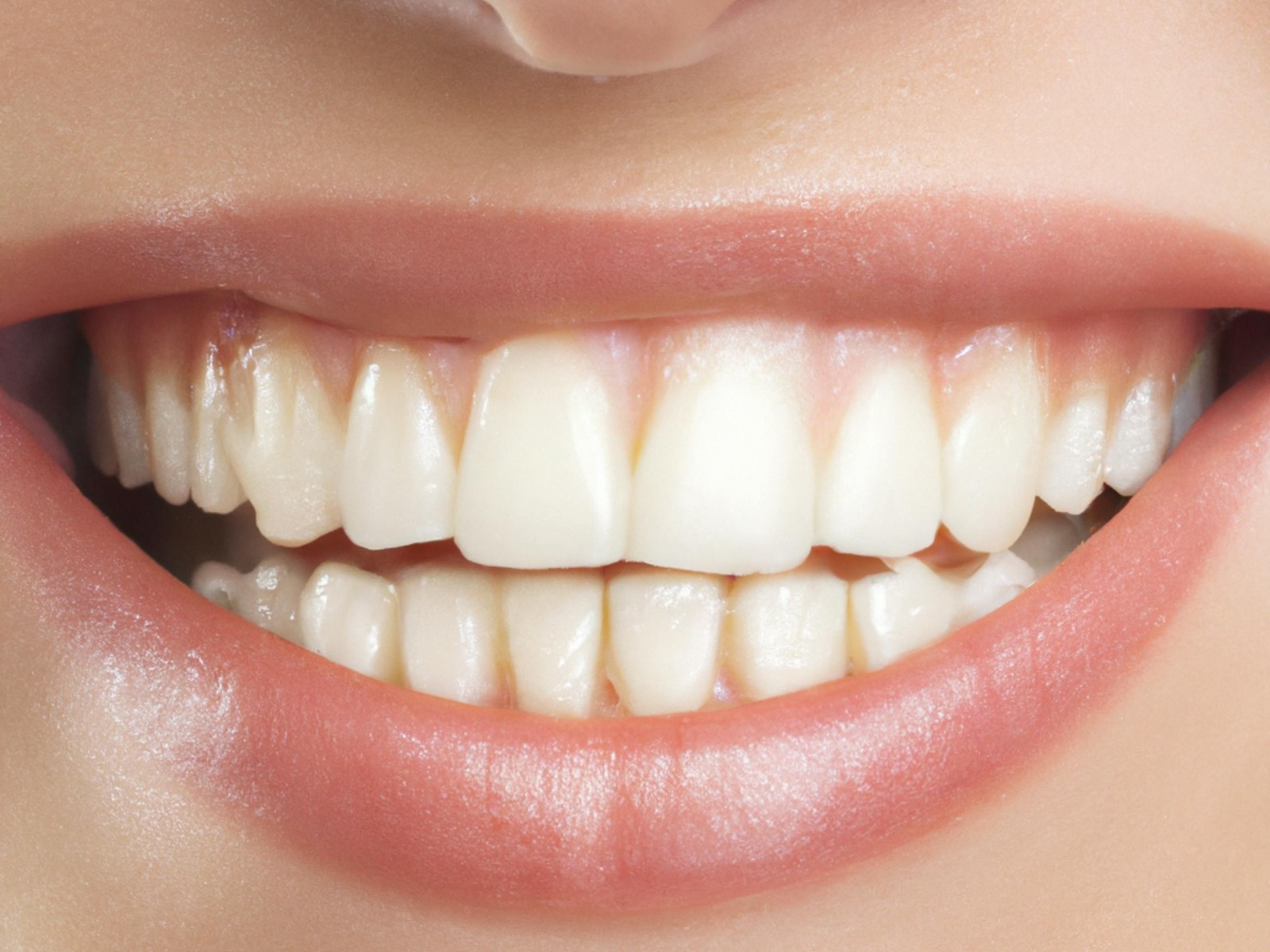 Dental laminates Navi Mumbai